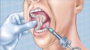 Проводниковая анестезия в стоматологии фото
