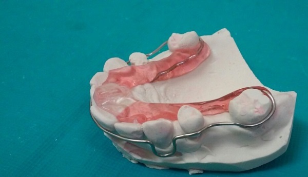 Изготовление депрограмматора койса в стоматологии