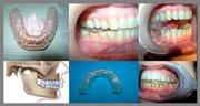 Сплинты в стоматологии