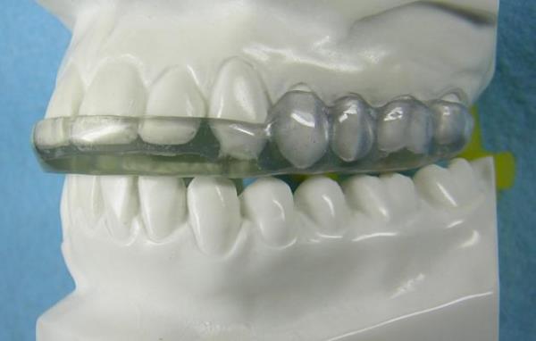 Сплинты в стоматологии