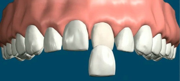 Выровнять передние зубы в домашних условиях