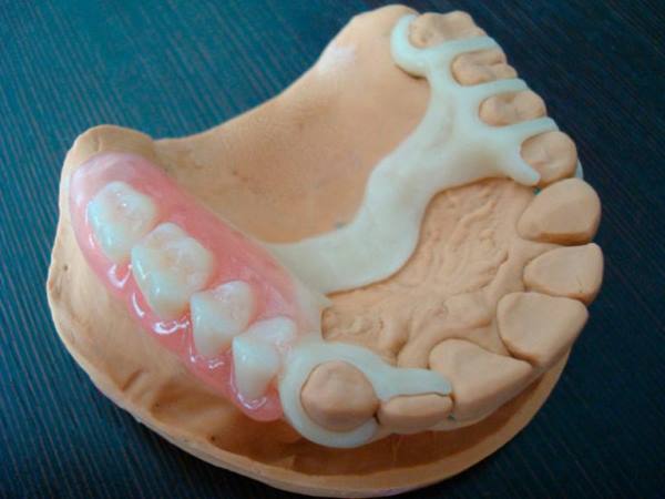 Недорогие зубные протезы несъемные