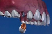 Причины отторжения зубных имплантов
