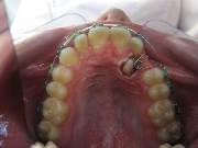 Вытяжение зуба