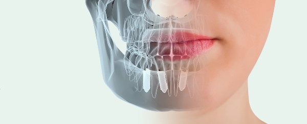 Имплантация зубов с использованием 3d технологии