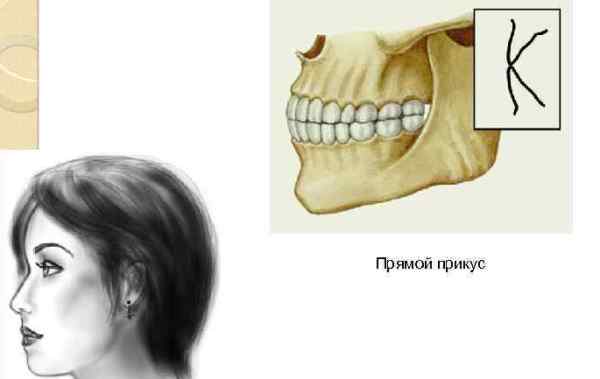 Фото прямого прикуса у человека и как исправить 