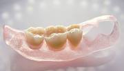 Особенности зубных протезов Vertex