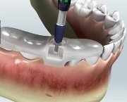 Особенности 3d имплантации зубов