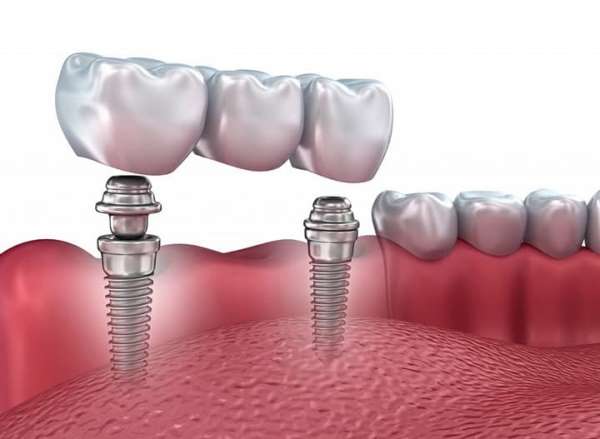 Плюсы и минусы имплантатов Oraltronics