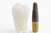 Kompressionnaia implantatciia zubov 1