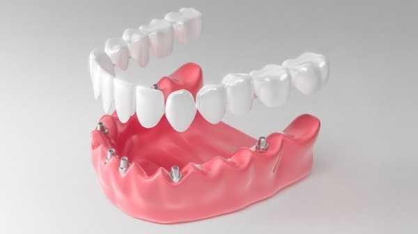 Методики имплантации зубов с немедленной нагрузкой