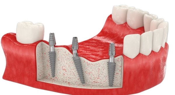 Имплантация жевательных зубов на нижней челюсти