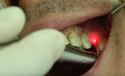 Лазерная имплантация зубов цена