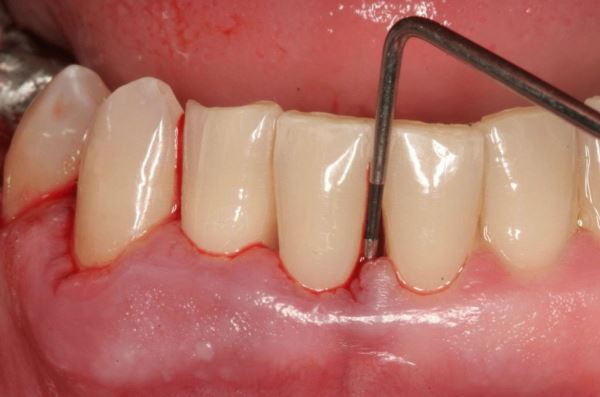Протезирование зубов при пародонтозе