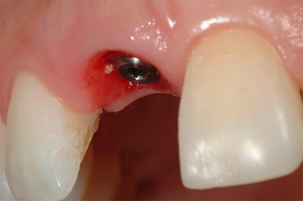 Болит зуб после имплантации