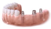 Имплантация нескольких зубов подряд отзывы
