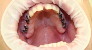 Имплантация жевательных зубов отзывы