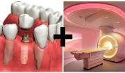 Можно делать МРТ с имплантами зубов