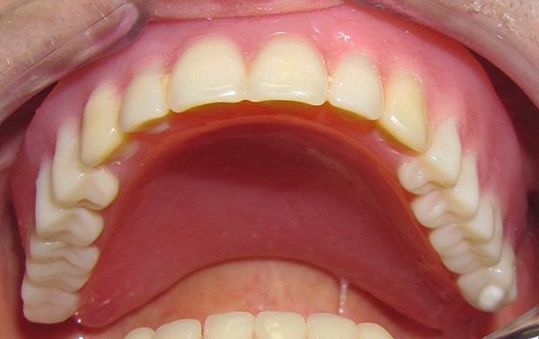 Как выглядит съемный зубной протез верхней челюсти