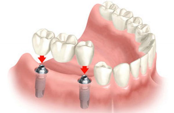 Системы для имплантации нескольких зубов подряд