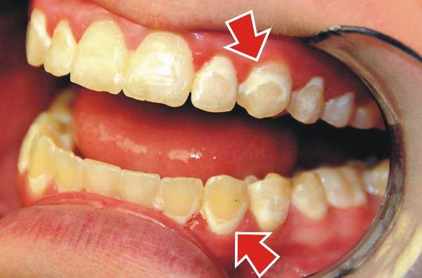 Отбеливание зубов после брекетов