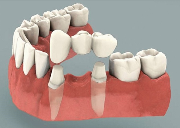Выбор опорных зубов для бюгельного протеза