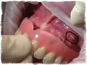Зубной протез натирает десну