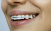 Пластины для выравнивания зубов у взрослых