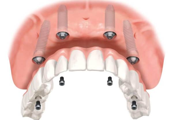 После удаления зуба когда можно делать протезирование