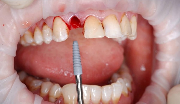 Протезирование сразу после удаления зубов через какое время