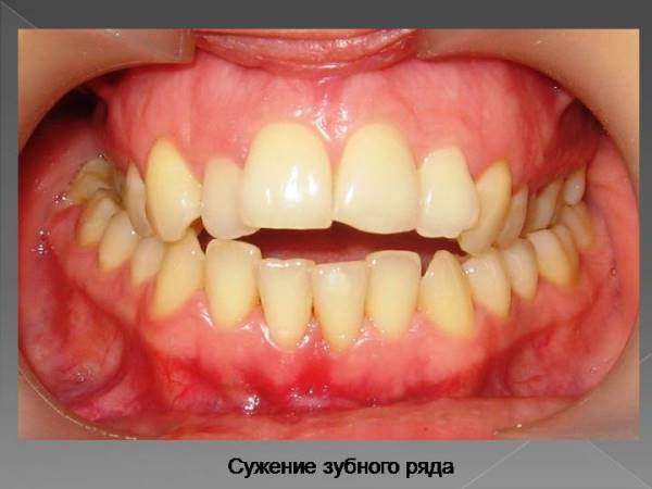 Классификация сужения челюстей и зубных рядов