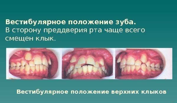 Вестибулярное отклонение зубов