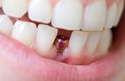 Выпадают импланты зубов причины