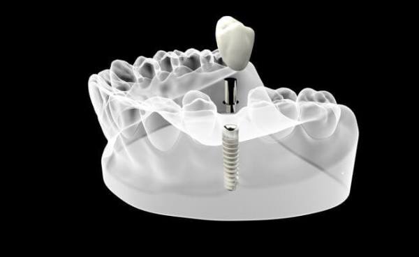 Как проводится имплантация нижних зубов