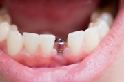Варианты имплантации зубов на нижней челюсти