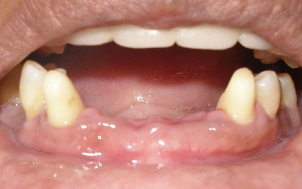 Съемные зубные протезы при частичном отсутствии зубов