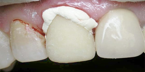 Безметалловые коронки на передние зубы