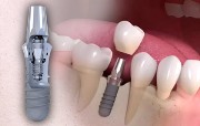 Из какого материала делают импланты для зубов