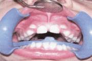 Вестибулярное положение зубов лечение