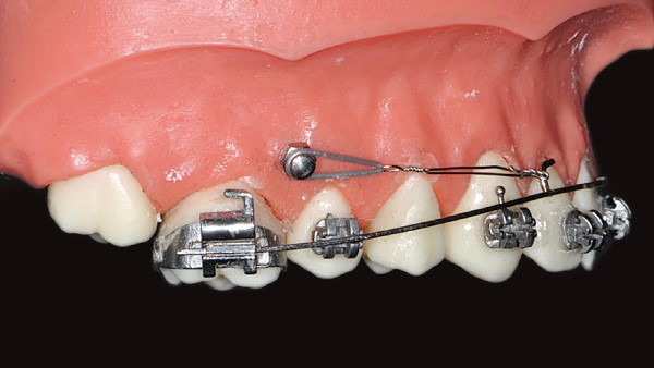 Характеристики анкоража в ортодонтии