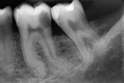 Инвагинация зуба лечение