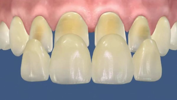 Препарирование зубов под керамические виниры