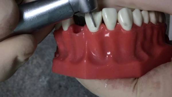 Препарирование зубов под виниры 5 методов обточки