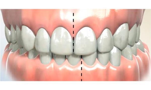 Смещение средней линии зубов исправить