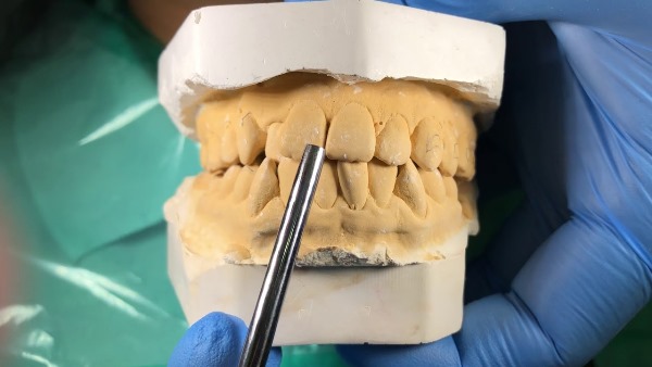 Смещение средней линии зубов из-за брекетов