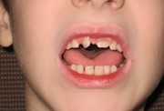 Тортоаномалия зубов лечение