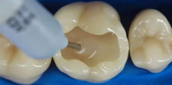 Основные компоненты прокладок для зубов