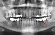 Киста под коронкой зуба лечение