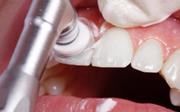 Методика чистки зубов Clinpro