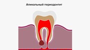 Острый апикальный периодонтит лечение